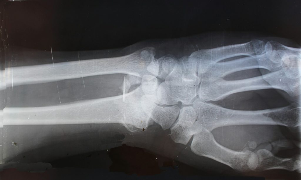 Hand X-Ray at Beam Radiology