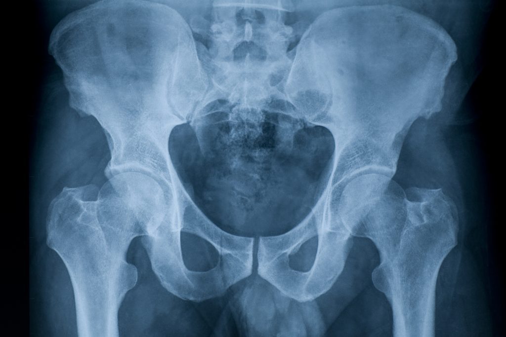 X-ray image of pelvis