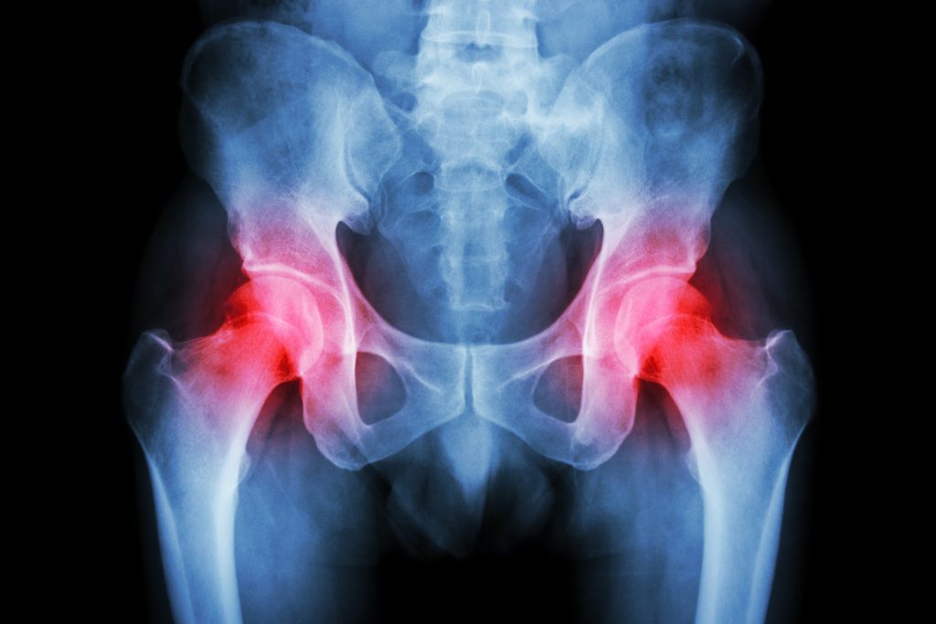 Film x-ray normal pelvis and arthritis both hip