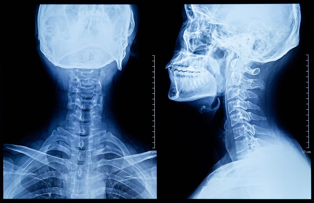 Human neck X-ray Film