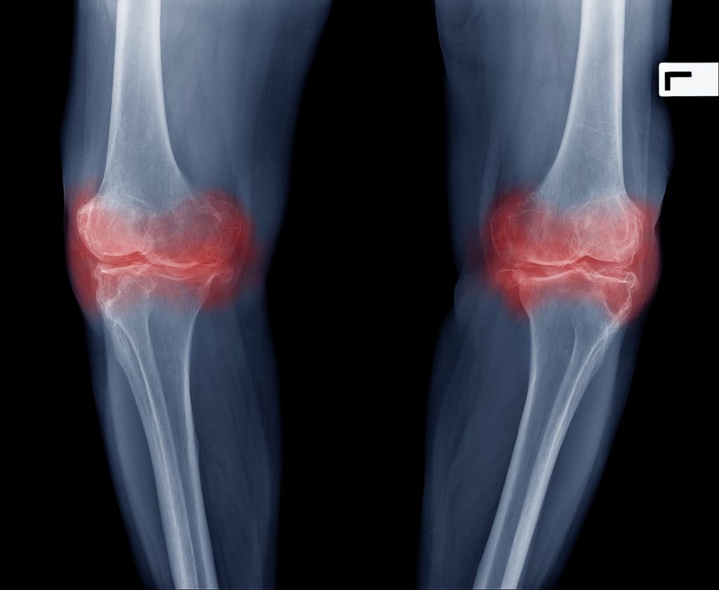 Xray image of senior woman knee pain show osteoarthritis both knee joint. Knee swelling and inflammation. Patient have serious pain when walking or standing.