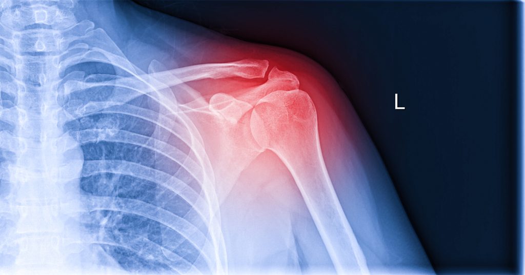 X-ray image of shoulder pain, shoulder ligament tendinitis, shoulder muscle strain