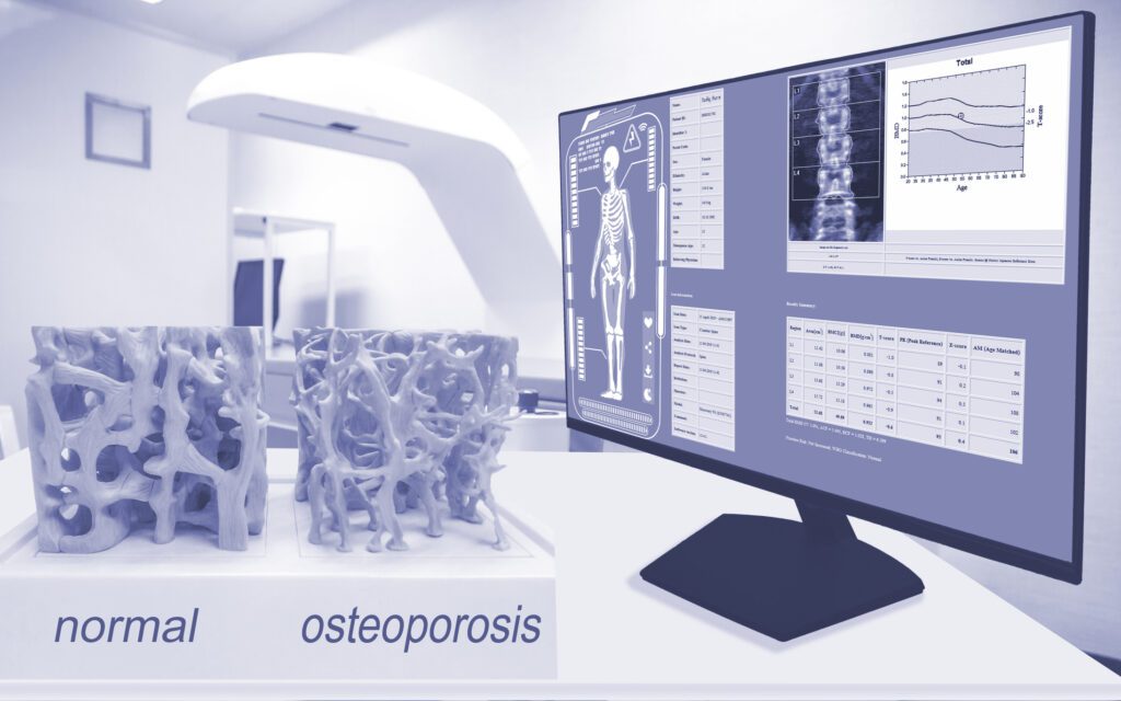Bone spongy structure close-ups, normal and with osteoporosis and showing on monitor and blurry room density background